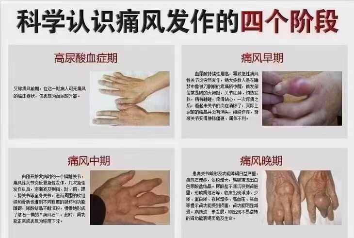 长期痛风、尿酸高、手脚关节肿痛、长夜难熬、长期骨痛、不用㤺-317首码网